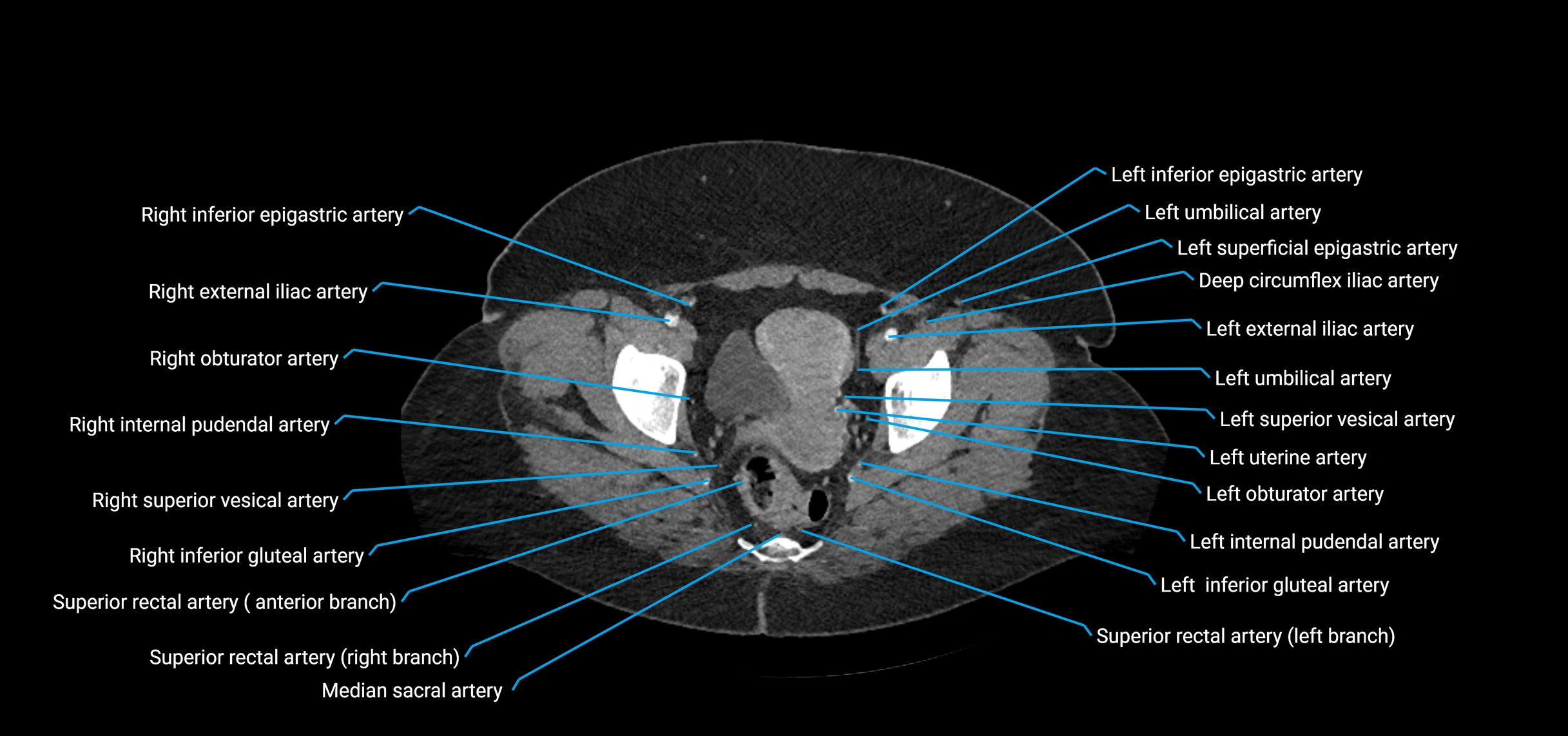 CTA abdomen axial cross sectional anatomy labelled image_231 (2).webp